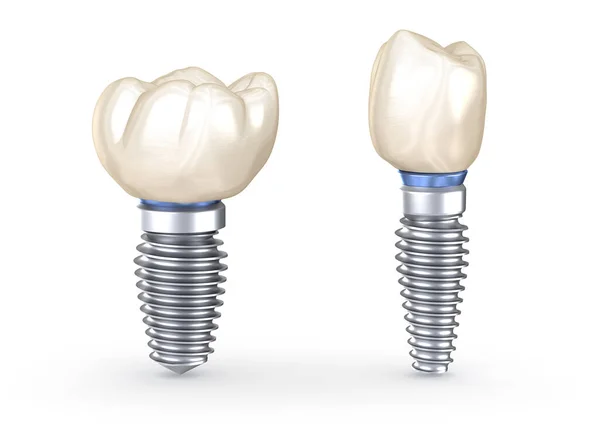 Implantes Dentales Ilustración Concepto Dientes Humanos —  Fotos de Stock