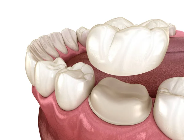 Förberedd Molar Tand För Tandkrona Placering Medicinskt Korrekt Illustration — Stockfoto