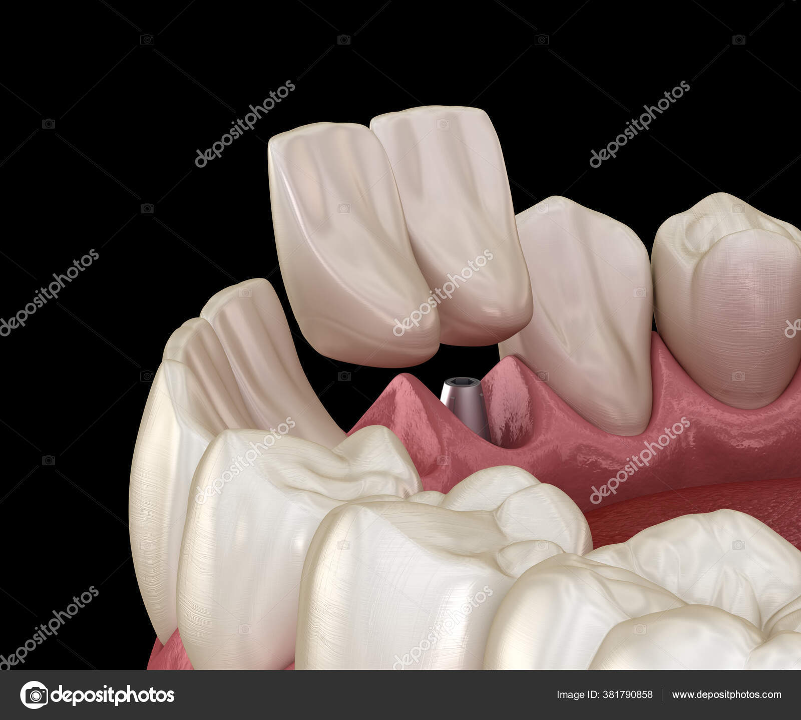 Cantilever Bridge Implant Based Frontal Tooth Recovery Medically