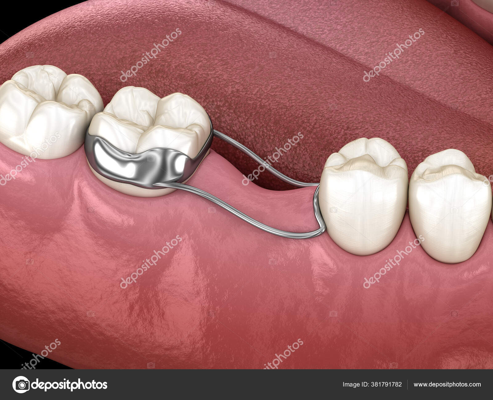 Space Maintainer Unilateral Keeps Teeth Shift Deformatiuon Losing Molar
