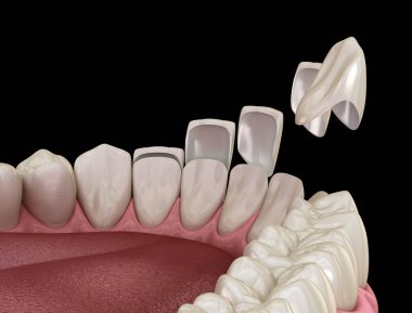 Merkezi kesici diş ve yan kesici dişler üzerinde vener kurulum prosedürü. Tıbbi olarak doğru diş 3D illüstrasyon