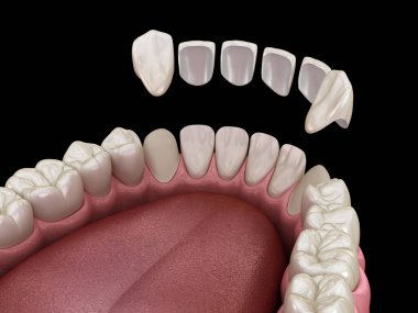 Merkezi kesici diş ve yan kesici dişler üzerinde vener kurulum prosedürü. Tıbbi olarak doğru diş 3D illüstrasyon
