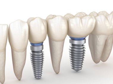 Dental Implants in line. 3D illustration concept of human teeth. clipart