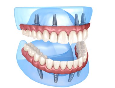 Çikletli Maxillary ve Mandibular protez hepsi de implantlarla desteklenen 4 sistemde. İnsan dişlerinin ve protezlerinin tıbbi açıdan doğru üç boyutlu çizimi
