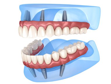 Çikletli Maxillary ve Mandibular protez hepsi de implantlarla desteklenen 4 sistemde. İnsan dişlerinin ve protezlerinin tıbbi açıdan doğru üç boyutlu çizimi