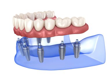 Çikletli Maxillary ve Mandibular protez. Hepsi de implantlarla desteklenen 8 sistemde. İnsan dişlerinin ve protezlerinin tıbbi açıdan doğru üç boyutlu çizimi