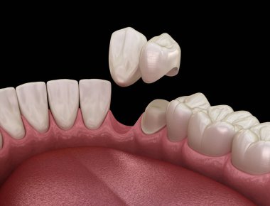 Cantilever Köprüsü, seramik ve ön dişlerden yapılmış. Diş konseptinin tıbben doğru 3 boyutlu animasyonu