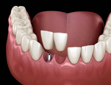 Cantilever Köprüsü implantı, ön diş tedavisi. Diş konseptinin tıbben doğru 3 boyutlu animasyonu