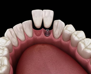 Cantilever Köprüsü implantı, ön diş tedavisi. Diş konseptinin tıbben doğru 3 boyutlu animasyonu