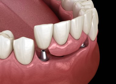 Ön diş köprüsü implantlarla destekleniyor. Diş konseptinin tıbben doğru 3D animasyonu