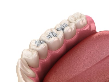 Amalgam restorasyonu. Diş konseptinin tıbben doğru 3 boyutlu animasyonu