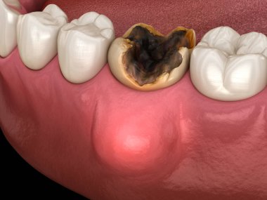 Periodontit ve diş eti iltihabı. Tıbbi olarak doğru olan 3 boyutlu diş illüstrasyonu