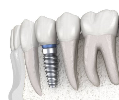 İmplantla azı dişi alınıyor. İnsan dişleri ve protez kavramının tıbben doğru üç boyutlu çizimi