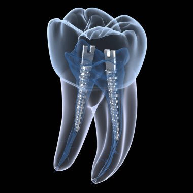 Azı dişlerinin içinde dişçi çeliği direği, röntgen görüntüsü. Diş içi endodontik tedavi 3 boyutlu illüstrasyon
