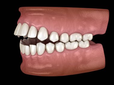 Openbite dental occlusion ( Malocclusion of teeth ). Medically accurate tooth 3D illustration clipart
