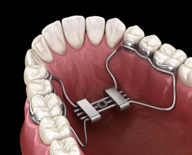 Hızlı Palatal Genişleme. Tıbbi olarak doğru diş 3D illüstrasyon