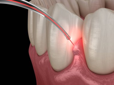 Lazerle sakız düzeltme ameliyatı. Tıbbi olarak doğru diş 3D illüstrasyon