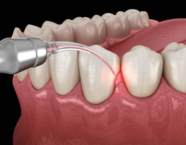 Lazerle sakız düzeltme ameliyatı. Tıbbi olarak doğru diş 3D illüstrasyon