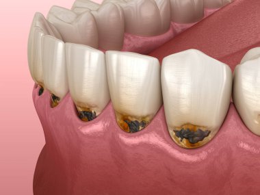 Ön dişlerde servikal bakteriler. Tıbbi olarak doğru diş 3D illüstrasyon.