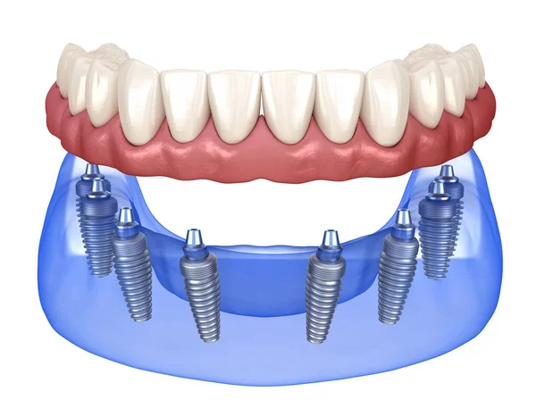 インプラントでサポートされている8つのシステム上のすべてのガムで上顎および顎関節の義肢 人間の歯と入れ歯の医学的に正確な3Dイラスト — ストック写真