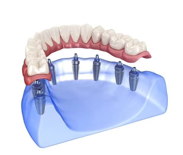 Proteza Maxillary Mandibular Gumą Wszystko System Obsługiwany Przez Implanty Medycznie — Zdjęcie stockowe