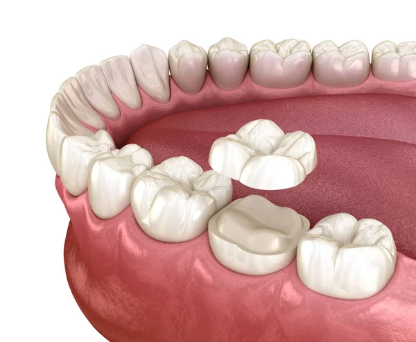 Onlay Fixação Coroa Cerâmica Sobre Dente Molar Ilustração Medicamente Precisa — Fotografia de Stock