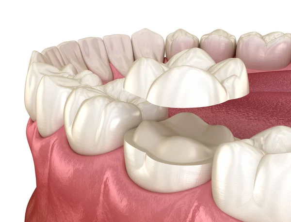 臼歯の上にセラミッククラウン固定のみ 人間の歯の治療の医学的に正確な3Dイラスト — ストック写真