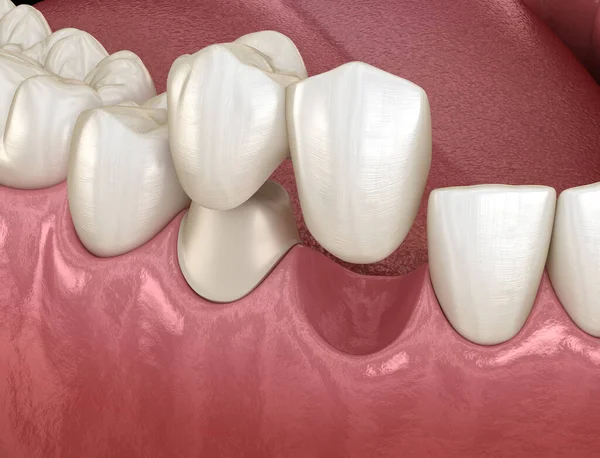 Ponte Cantilever Feita Cerâmica Recuperação Dentes Frontal Animação Medicamente Precisa — Fotografia de Stock