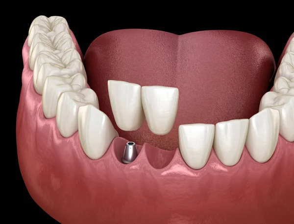 Implante Ponte Cantilever Recuperação Dente Frontal Animação Medicamente Precisa Conceito — Fotografia de Stock