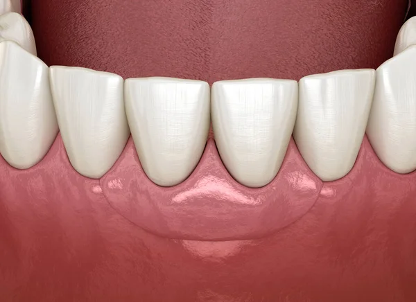 Dentes Frontais Ponte Apoiada Por Implantes Animação Medicamente Precisa Conceito — Fotografia de Stock