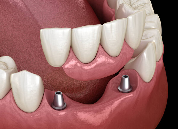 Frontal teeth bridge supported by implants. Medically accurate 3D animation of dental concept