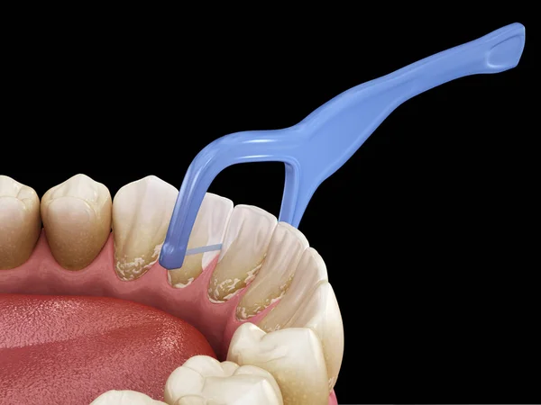 Orale Hygiëne Tandenstoker Tandzijde Gebruiken Voedsel Geplakt Uit Tanden Verwijderen — Stockfoto