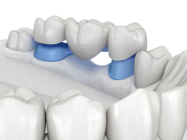 Porcelanowy Most Stomatologiczny Zębami Trzonowymi Przedtrzonowymi Medycznie Dokładna Ilustracja Leczenia — Zdjęcie stockowe