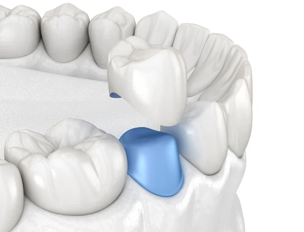 Posizionamento Corona Porcellana Sopra Dente Premolare Illustrazione Clinicamente Accurata — Foto Stock