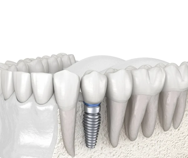 前磨牙修复植入物 医学上准确的人类牙齿和假牙概念三维图像 — 图库照片