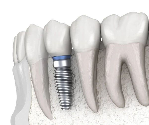 Recuperação Dentes Pré Molares Com Implante Ilustração Medicamente Precisa Conceito — Fotografia de Stock