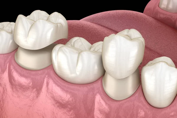 Πορσελάνη Κορώνες Τοποθέτηση Πάνω Από Προγόμφιος Και Γομφίος Δόντια Ιατρικά — Φωτογραφία Αρχείου