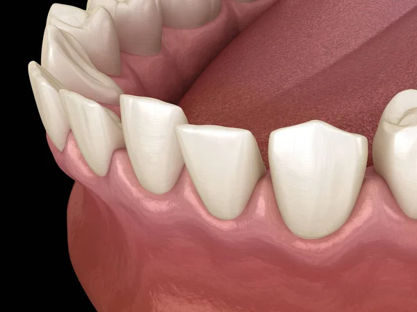 牙齿之间间隔过长 牙科3D图解概念 — 图库照片