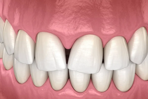 中央门牙收缩性乳突 牙科功能障碍3D图解概念 — 图库照片