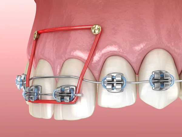 Elastici Bretelle Metalliche Correzione Overbite Incisivi Frontali Illustrazione Dentale Clinicamente — Foto Stock