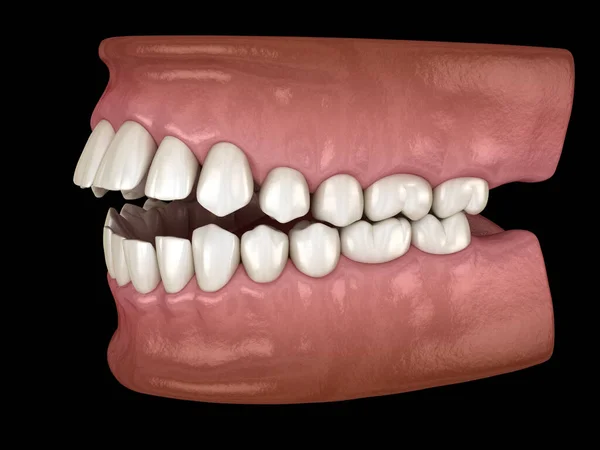 Öppningsbett Dentala Ocklusion Malocclusion Tänder Medicinskt Korrekt Tand Illustration — Stockfoto