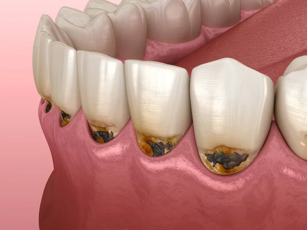 Caries Cervicales Sur Les Dents Frontales Illustration Dentaire Médicalement Précise — Photo