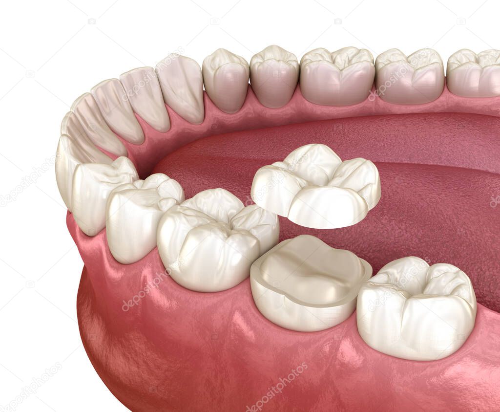 Onlay ceramic crown fixation over molar tooth. Medically accurate 3D illustration of human teeth treatment