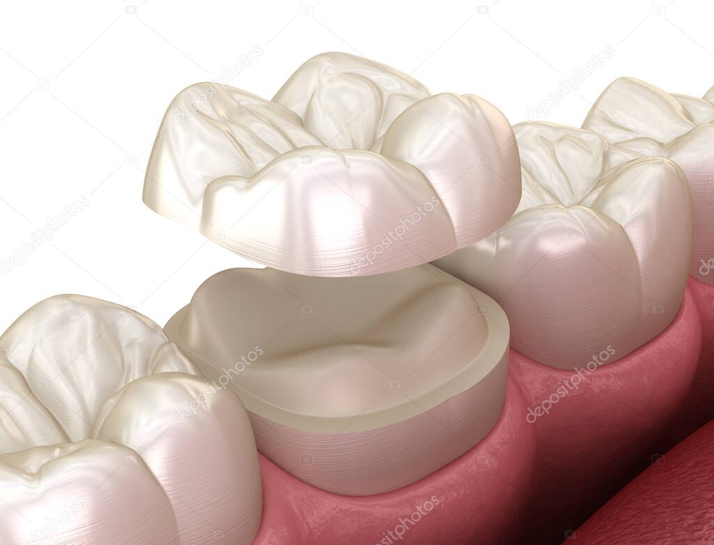 Onlay ceramic crown fixation over molar tooth. Medically accurate 3D illustration of human teeth treatment