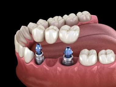Diş köprüsü implantlarla destekleniyor. İnsan dişleri ve protez kavramının tıbben doğru üç boyutlu çizimi