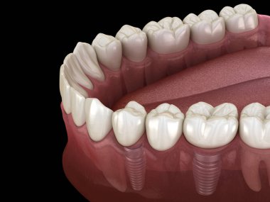 Diş köprüsü implantlarla destekleniyor. İnsan dişleri ve protez kavramının tıbben doğru üç boyutlu çizimi