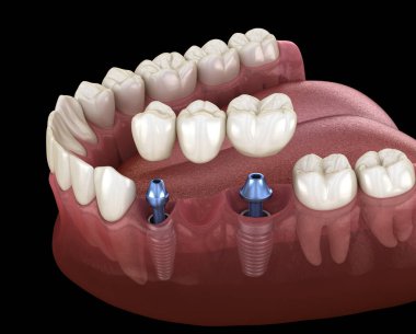 Diş köprüsü implantlarla destekleniyor. İnsan dişleri ve protez kavramının tıbben doğru üç boyutlu çizimi