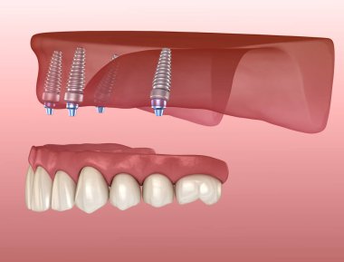 Çikletli Maxillary protezi. Hepsi de implantlarla desteklenen 4 sistemde. İnsan dişlerinin ve protezlerinin tıbbi açıdan doğru üç boyutlu çizimi