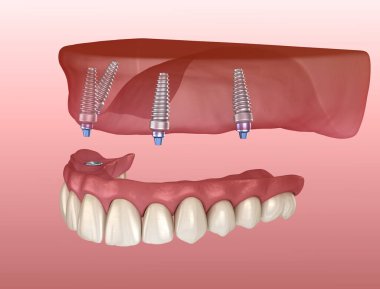 Çikletli Maxillary protezi. Hepsi de implantlarla desteklenen 4 sistemde. İnsan dişlerinin ve protezlerinin tıbbi açıdan doğru üç boyutlu çizimi
