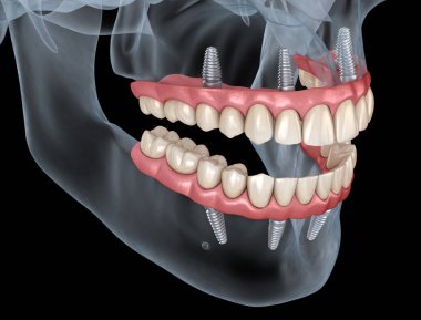 Çikletli Maxillary ve Mandibular protez hepsi de implantlarla desteklenen 4 sistemde. İnsan dişlerinin ve protezlerinin tıbbi açıdan doğru üç boyutlu çizimi